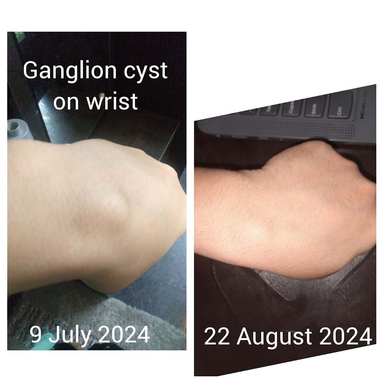 Ganglion Cyst Resolution